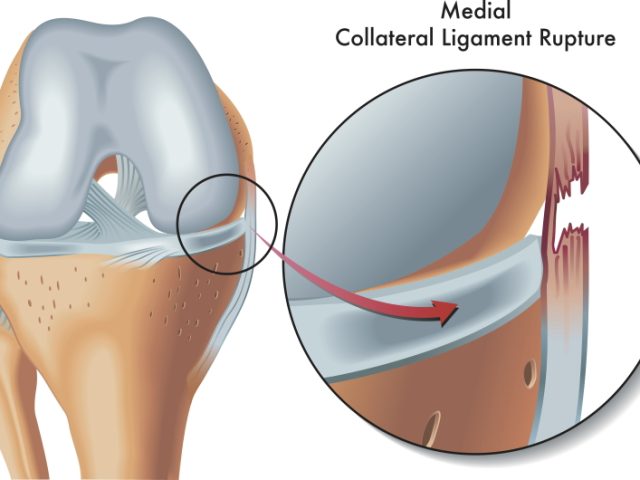 medial collateral tear