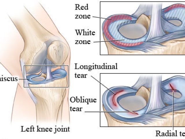 meniscal tear